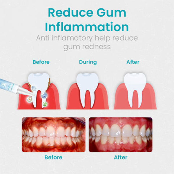NESLEMY Gum Shield Therapy Gel