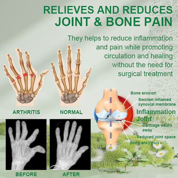🐝New Zealand Bee Poison Joint and Bone Therapy Advanced Cream⏳Limited time discount of 80%⏳