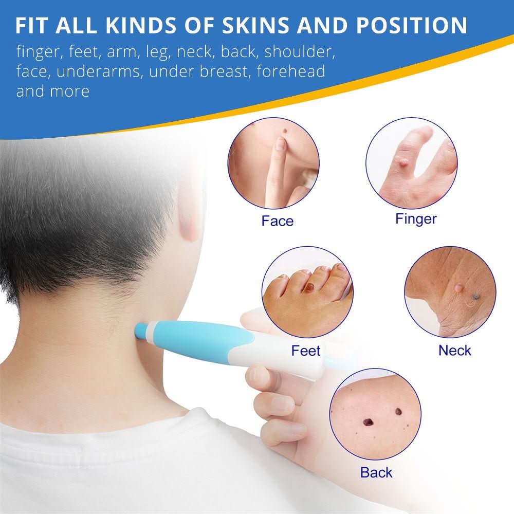 EPICLEAR – At-Home Skin Tag & Wart Remover Kit