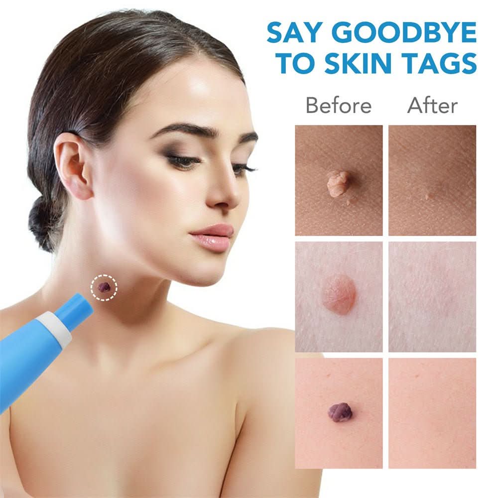 EPICLEAR – At-Home Skin Tag & Wart Remover Kit