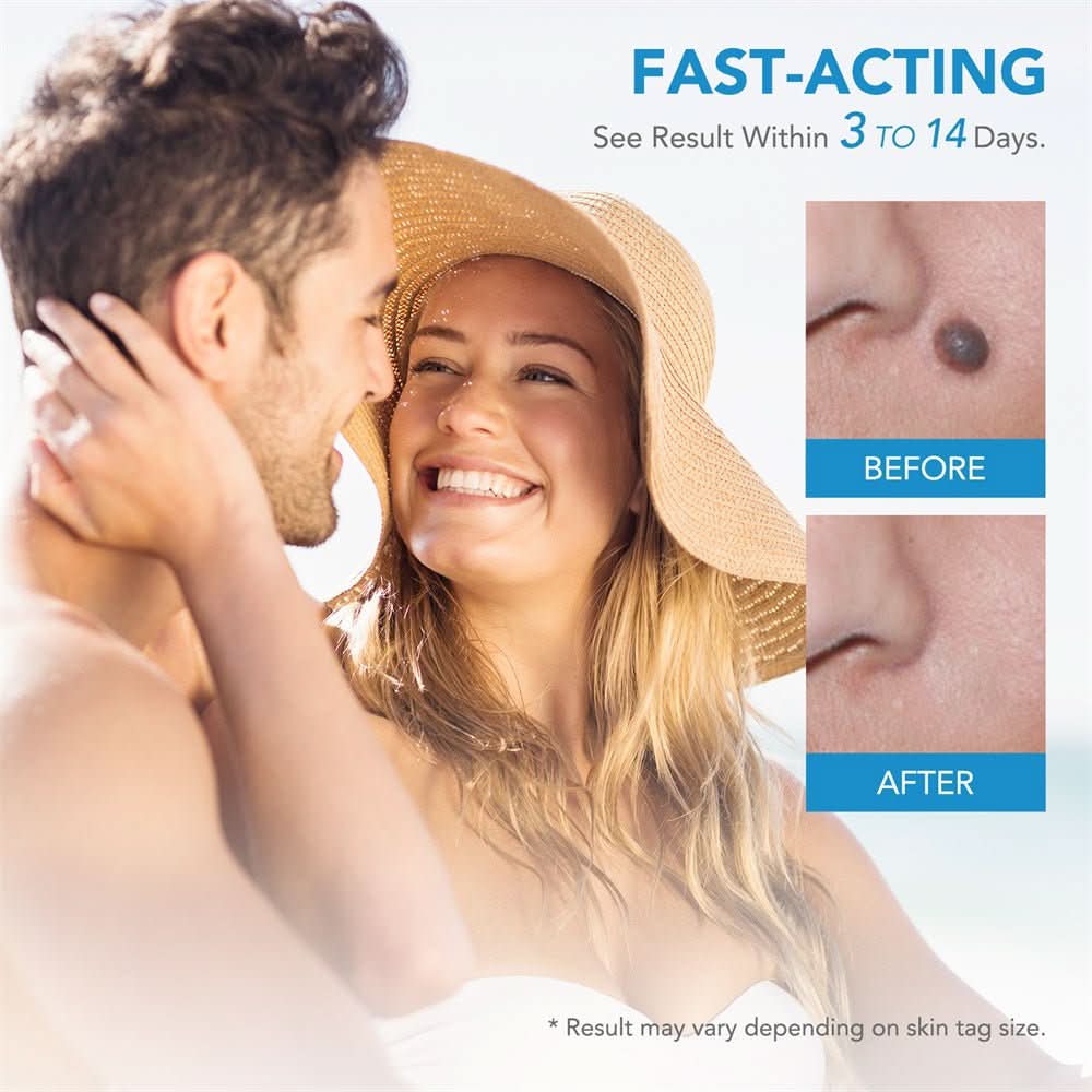 EPICLEAR – At-Home Skin Tag & Wart Remover Kit