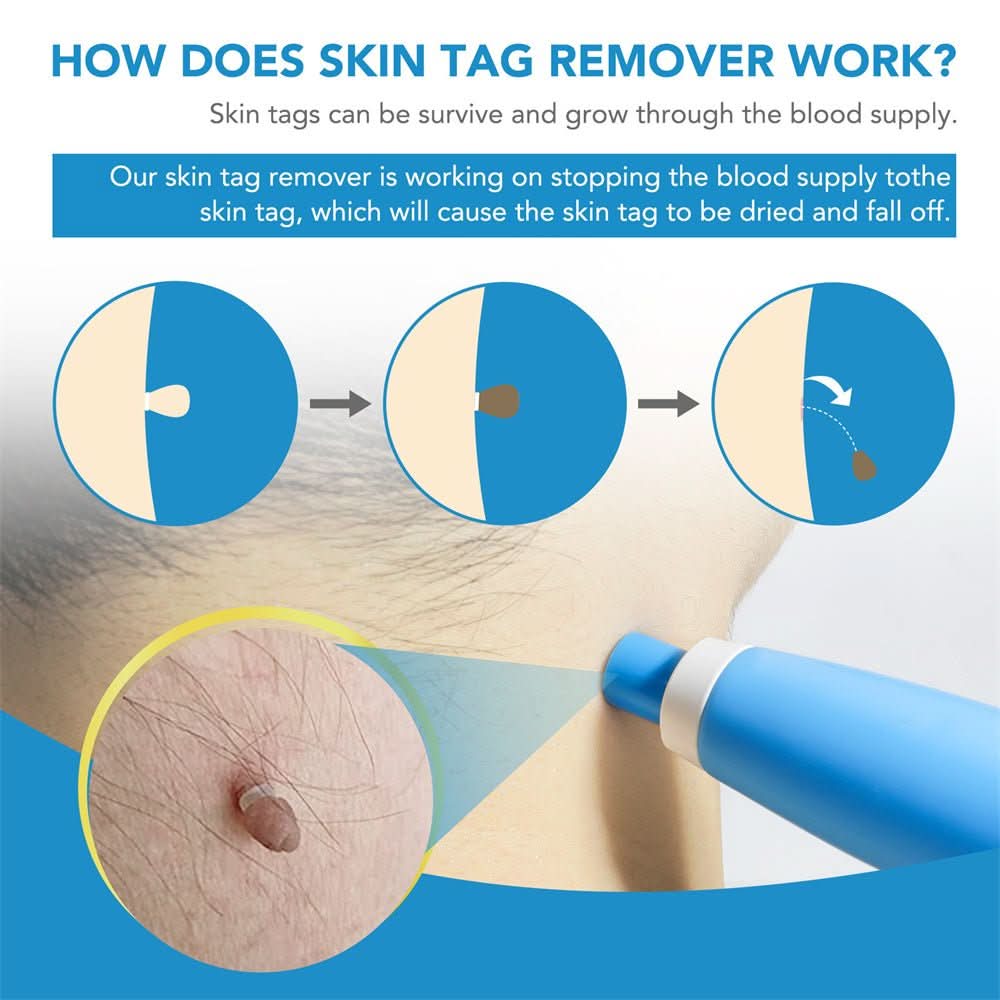 EPICLEAR – At-Home Skin Tag & Wart Remover Kit