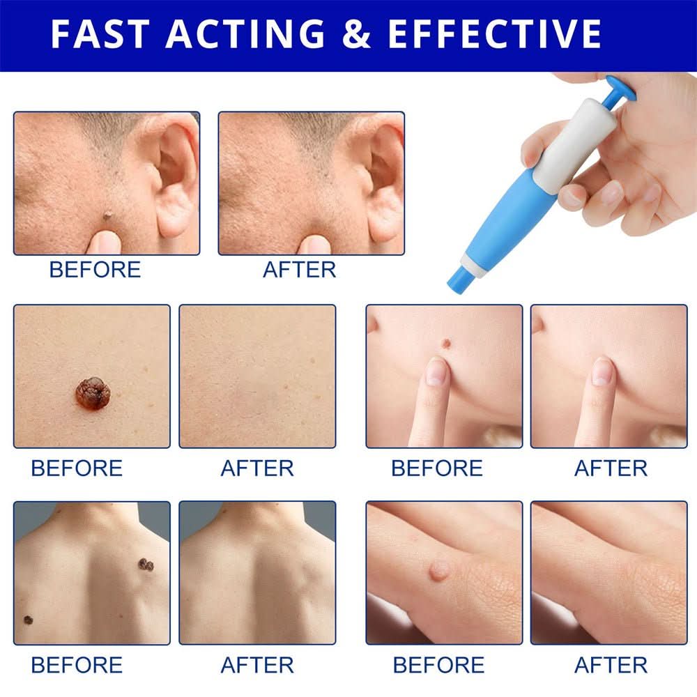 EPICLEAR – At-Home Skin Tag & Wart Remover Kit