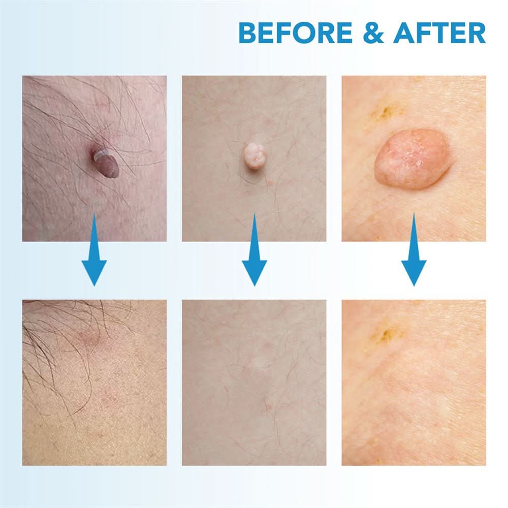 EPICLEAR – At-Home Skin Tag & Wart Remover Kit