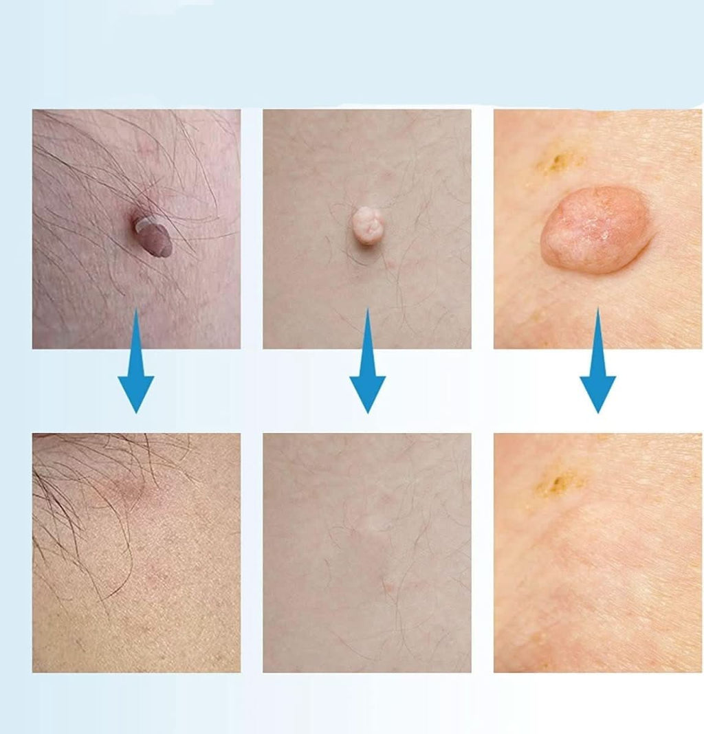 EPICLEAR – At-Home Skin Tag & Wart Remover Kit