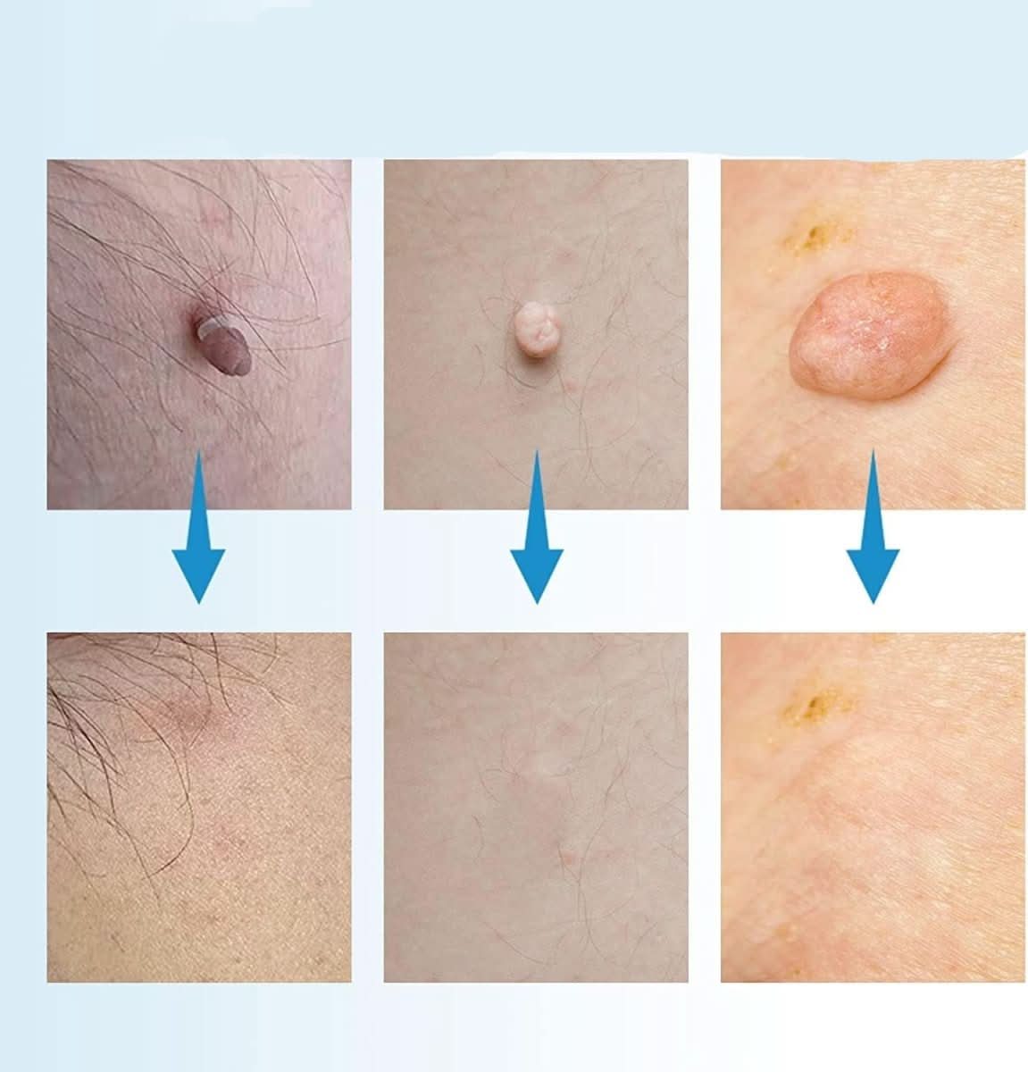EPICLEAR – At-Home Skin Tag & Wart Remover Kit