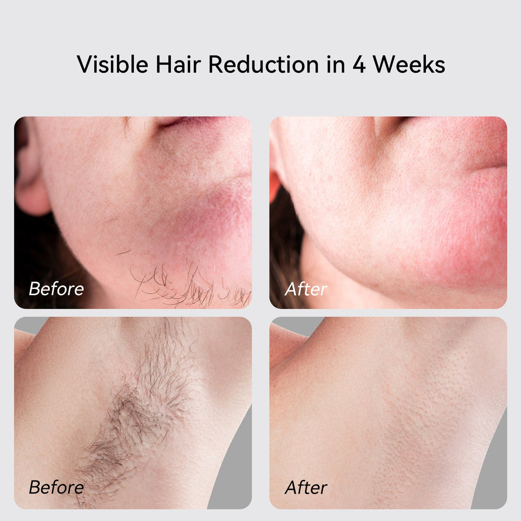 Thorntons VIP Beauty X Sapphire IPL Hair Removal Handset