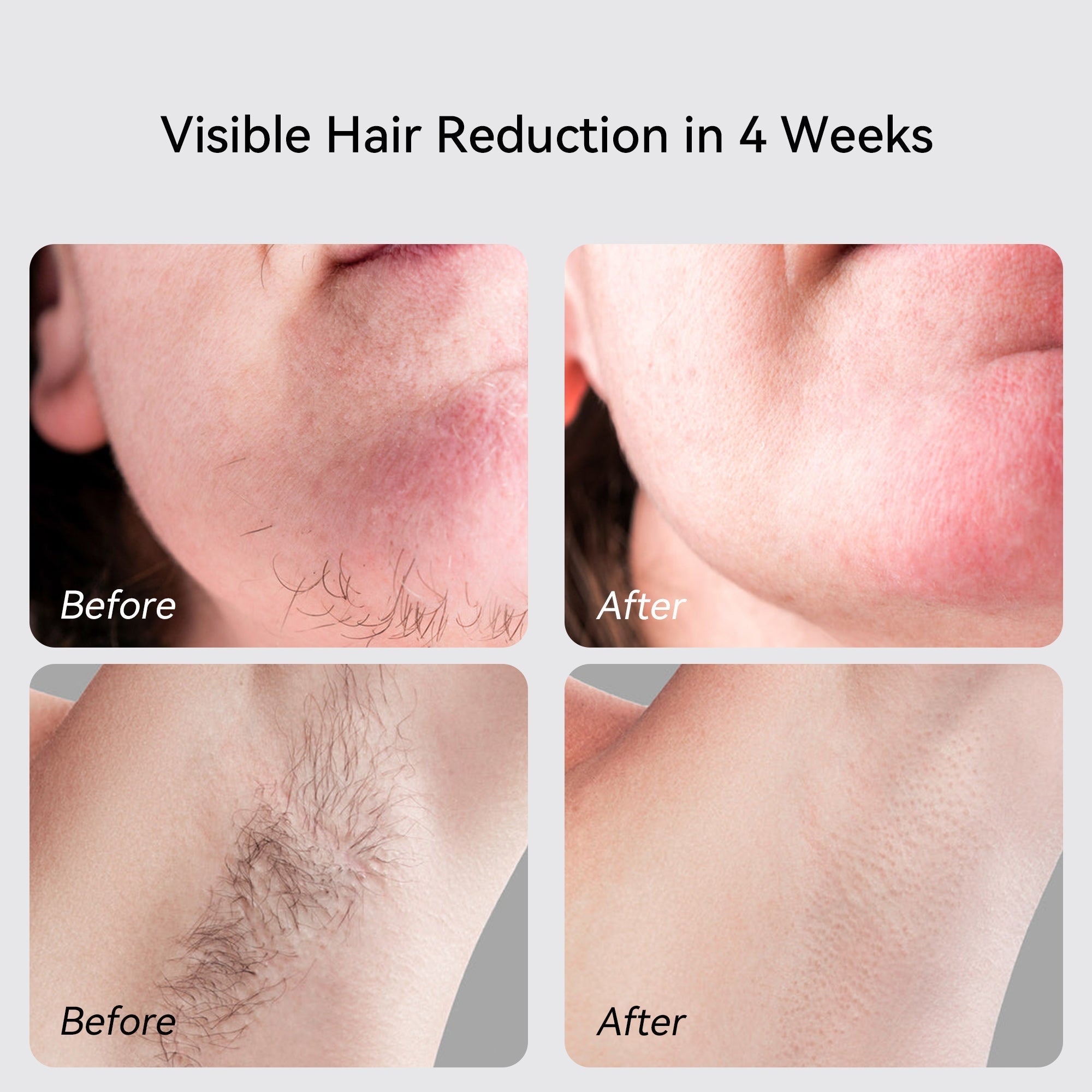 Thorntons VIP Beauty X Sapphire IPL Hair Removal Handset